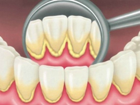 tartrul dentar davinci